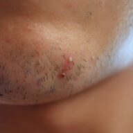 カミソリ負けを治したい！肌荒れを治したい。この気持ちでアバオ・アクーを開発しました。